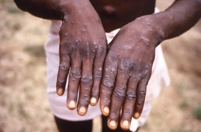 No Monkeypox detected in Western Region - Health Authorities