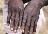 One monkeypox-related death recorded in Bolgatanga