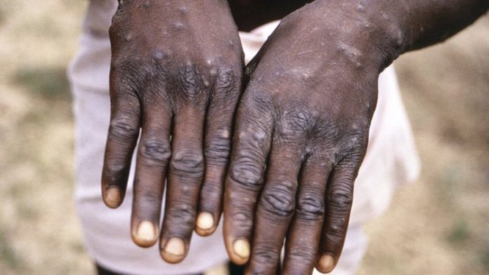 One monkeypox-related death recorded in Bolgatanga