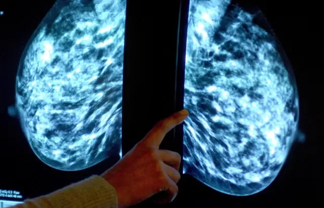 AI offers huge promise on breast cancer screening