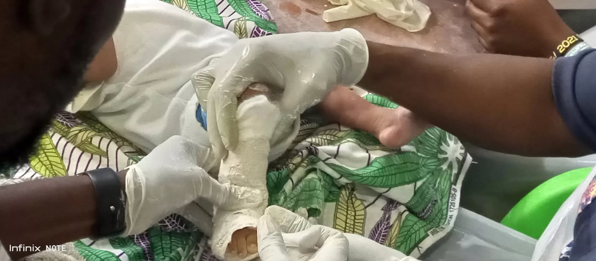 Babies with clubfoot receive free treatment; physiotherapists trained in management of condition