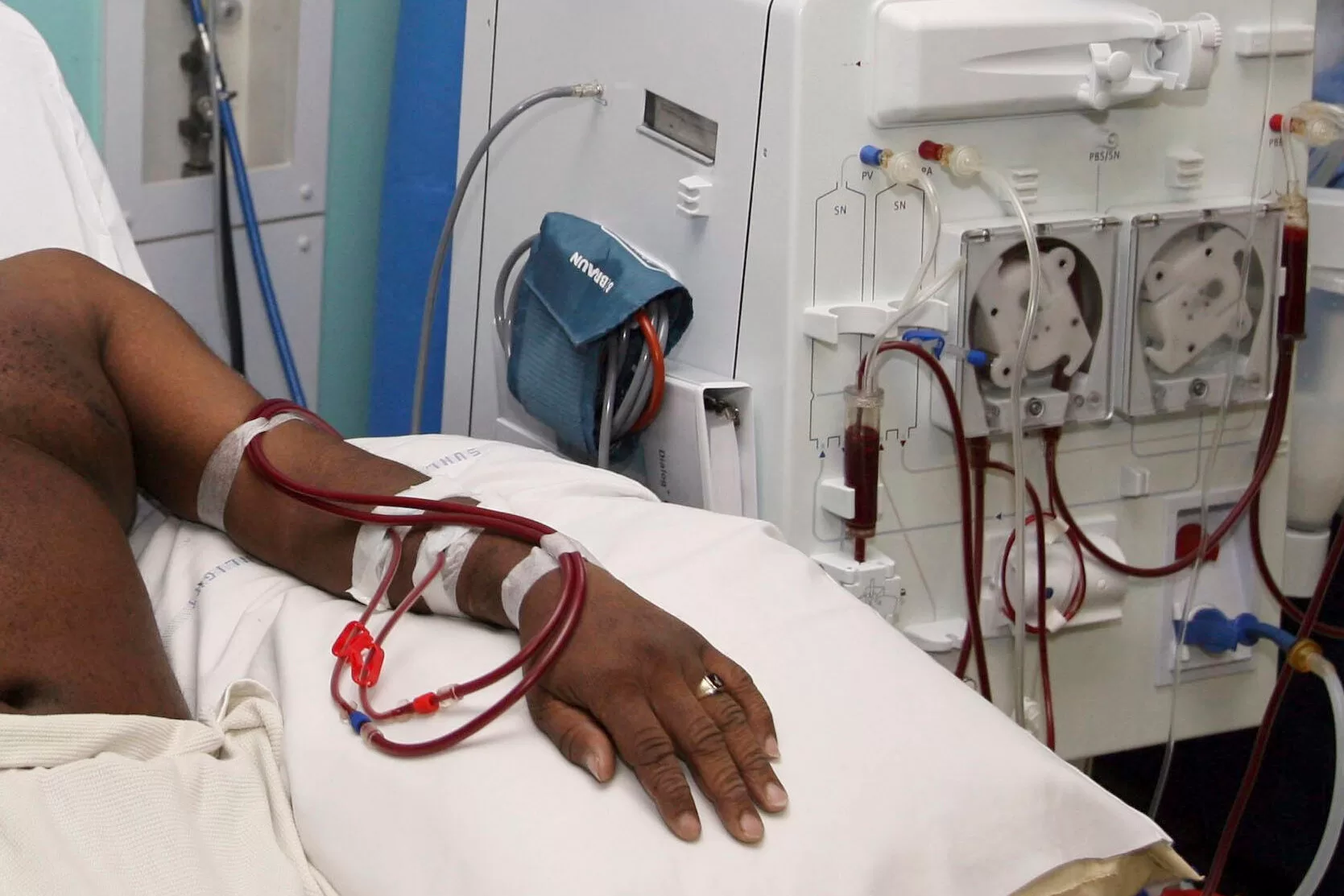 Government explores subsides for dialysis treatment amid rising cost of kidney treatment