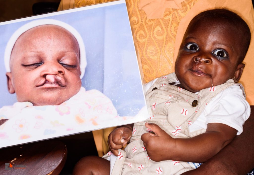 GRAFT Foundation to offer free reconstructive surgeries in Ashanti Region