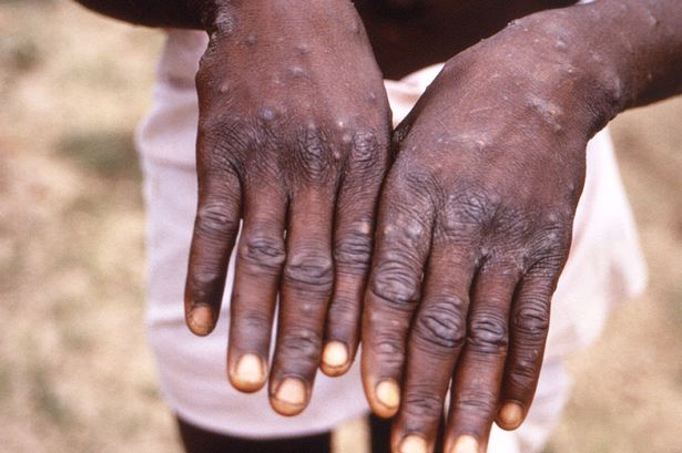 Ghana confirms 10 new mpox cases, bringing total to 19