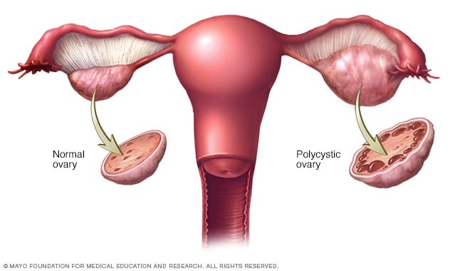 PCOS: Understanding the silent hormonal disorder affecting millions of women