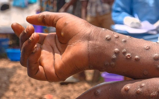 Africa's Mpox crisis intensifies as WHO renews global public health emergency
